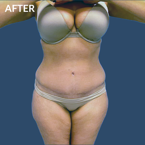 LMpostabdominoplasty