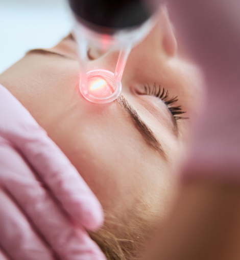 laser treatments