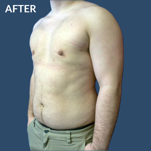 BFpostgynecomastia