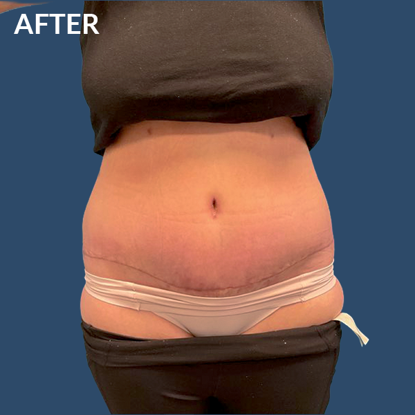 SApostabdominoplasty