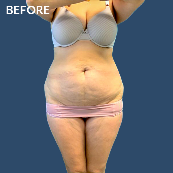 SApreabdominoplasty